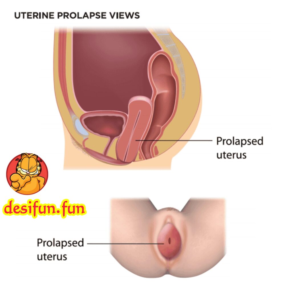 What is uterine prolapse? Why does it happen? How to treat it?