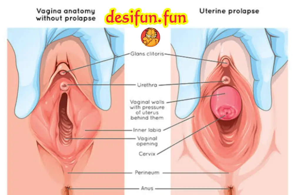 What is uterine prolapse? Why does it happen? How to treat it?