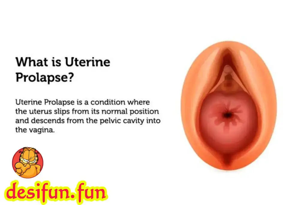 What is uterine prolapse? Why does it happen? How to treat it?