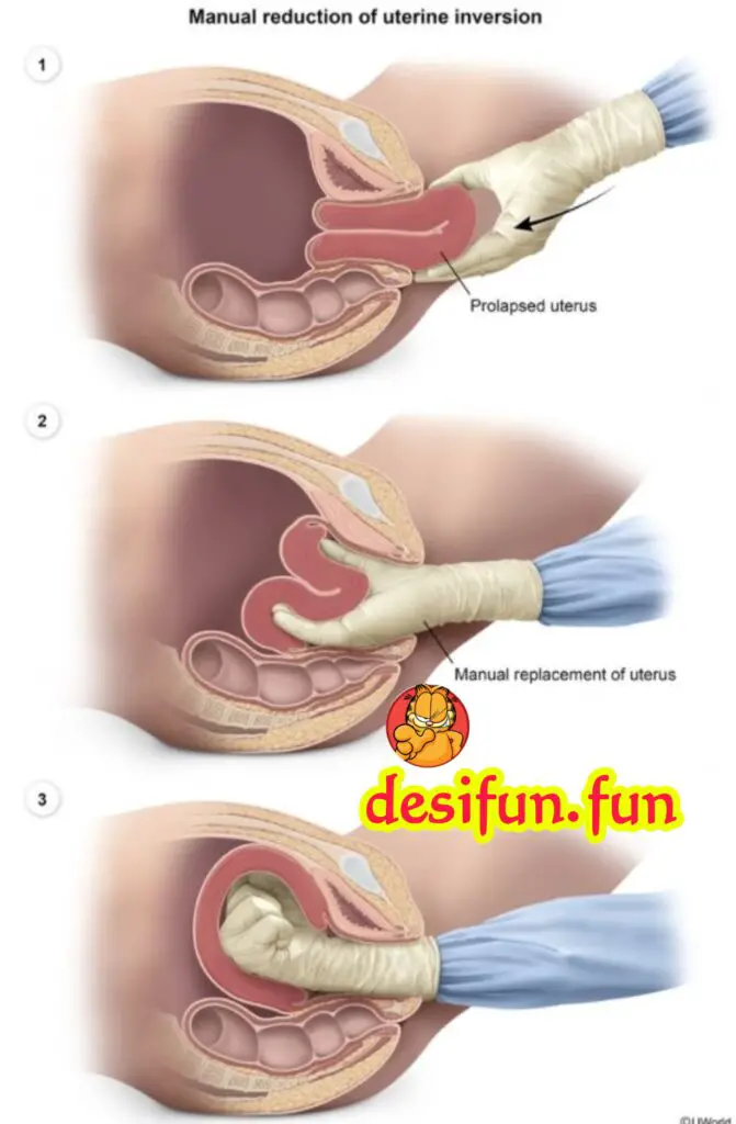 What is uterine prolapse? Why does it happen? How to treat it?