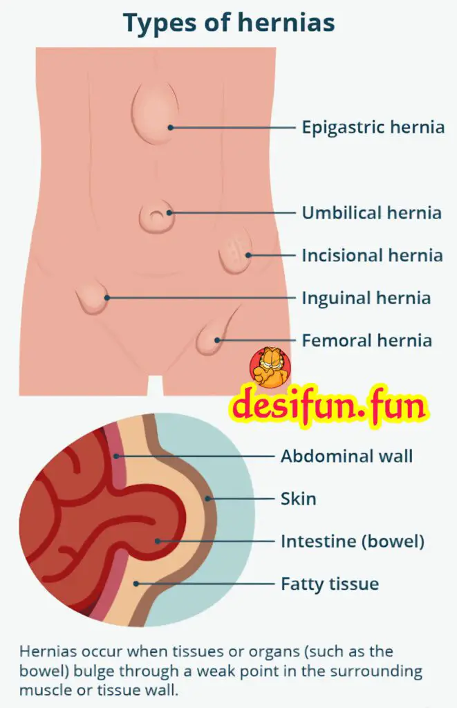 What is a hernia? Is there any solution for it?