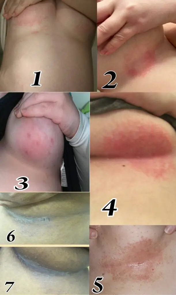 How to remove dark spots on private parts of the body?